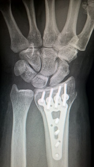 broken arm, plate fixation, titanium plate