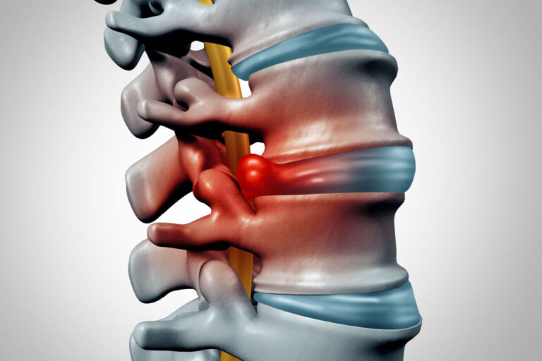 bulging disc car accident settlement