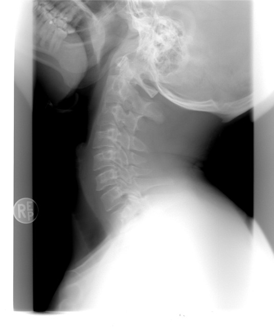xray, cervical spine, healthcare